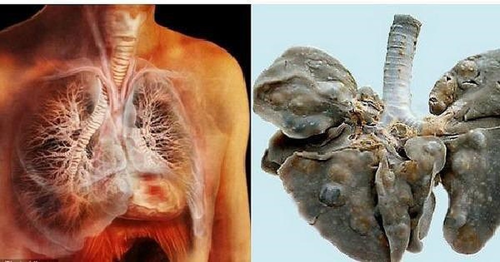 Sán lá phổi - Hình ảnh minh họa